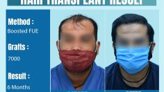 Best_hair_transplant_clinic_in_delhi